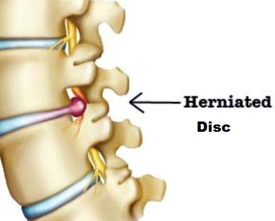 herniated1