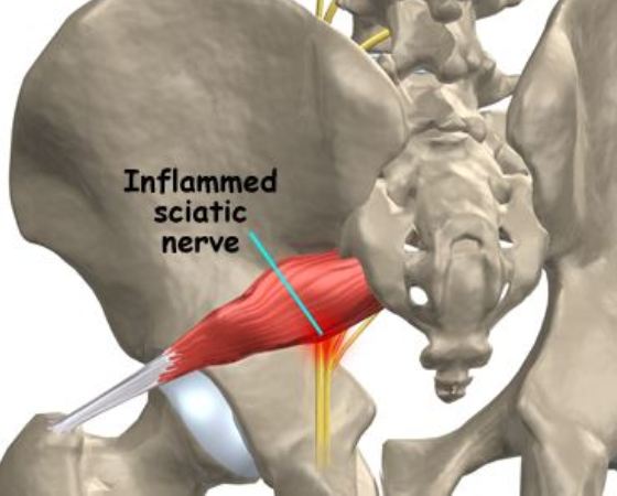 sciatic