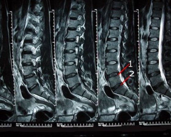 spinal_stenosis_