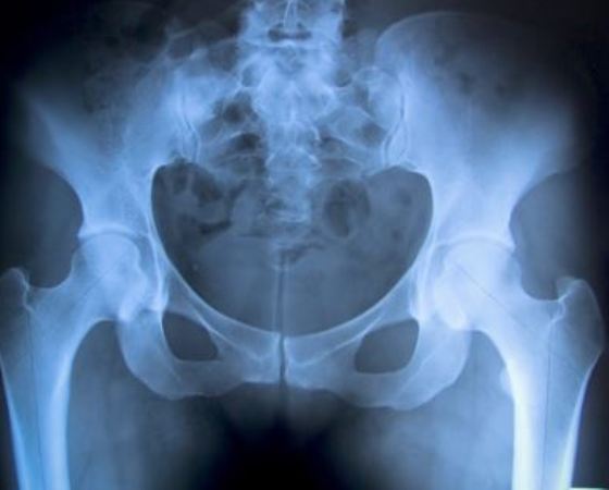 hip-fracture